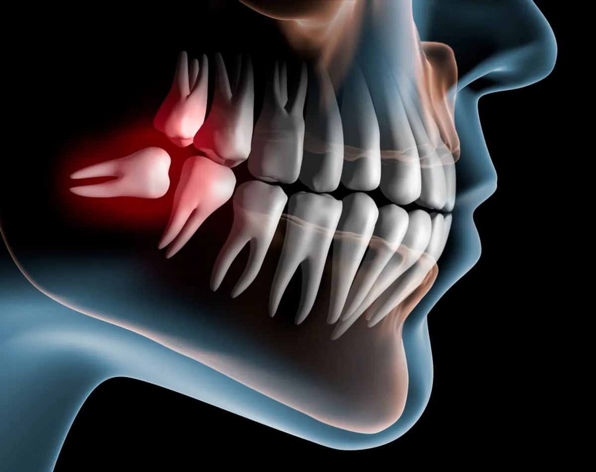 third molar course.jpg